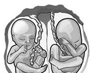 Особенности многоплодной беременности: вероятность, причины, виды Естественная многоплодная беременность
